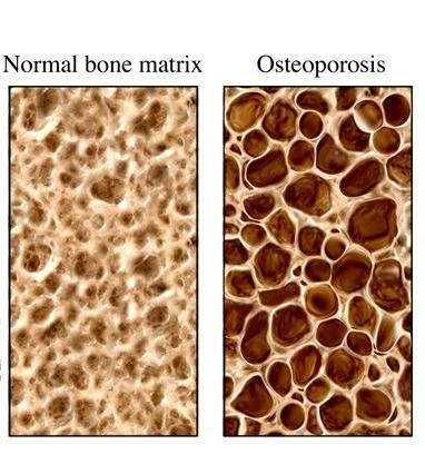 osteoporosis étrendje